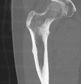Atypical femur fracture CT